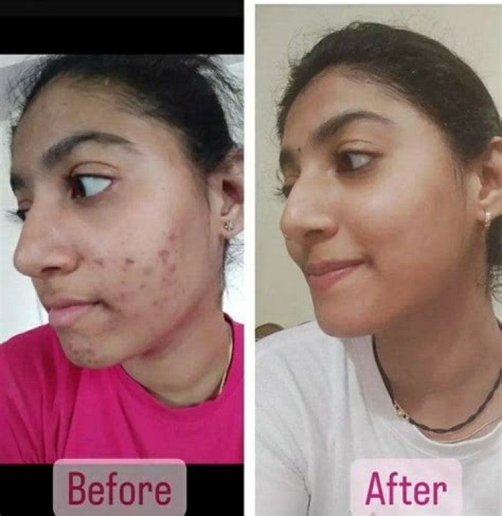 Kojic acid soap side effects Kojic acid soap side effects