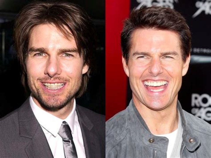 Tom Cruise with braces